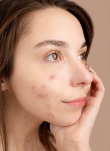 picture of a young woman with deep, painful, cystic, scarring, hormonal acne on her cheeks
