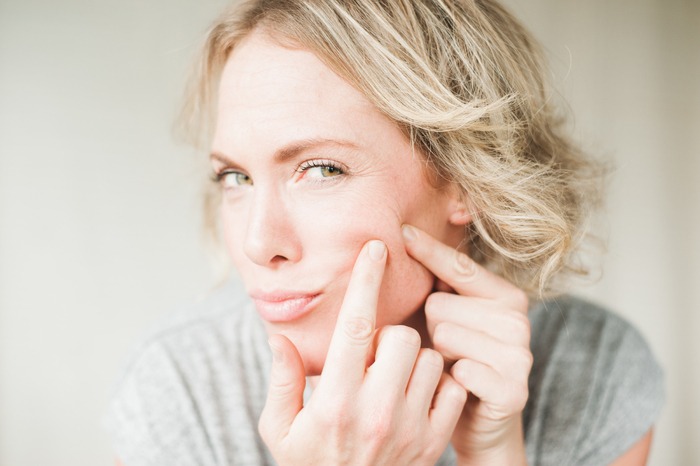 pcos acne on the chin, jawline, and cheeks, cystic acne, hormonal acne